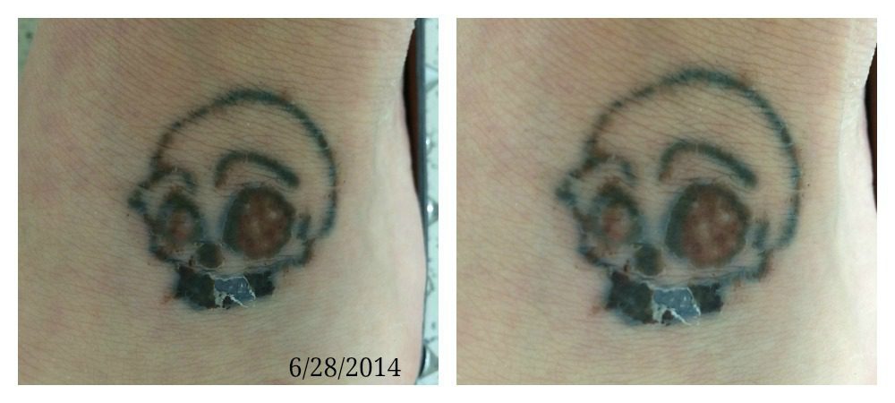 laser tattoo removal healing