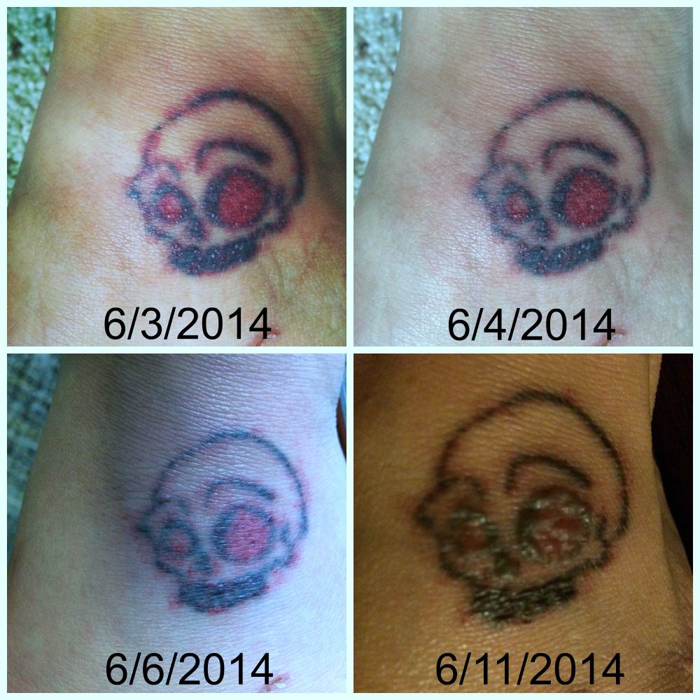 tattoo removal first round