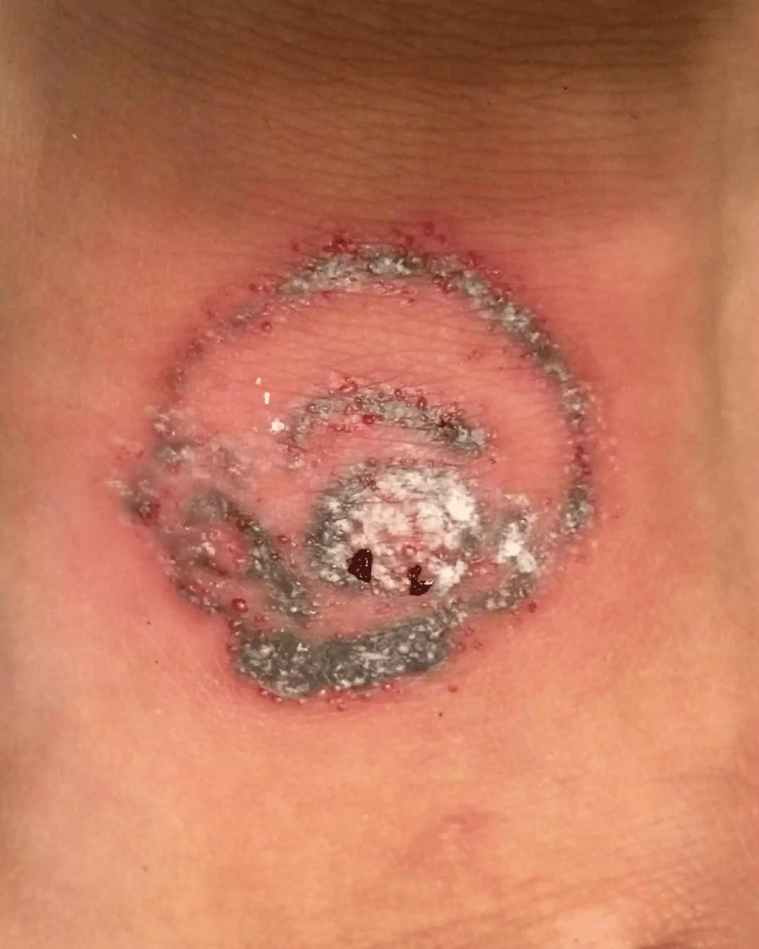 Tattoo Removal: A Diary (With Pictures)